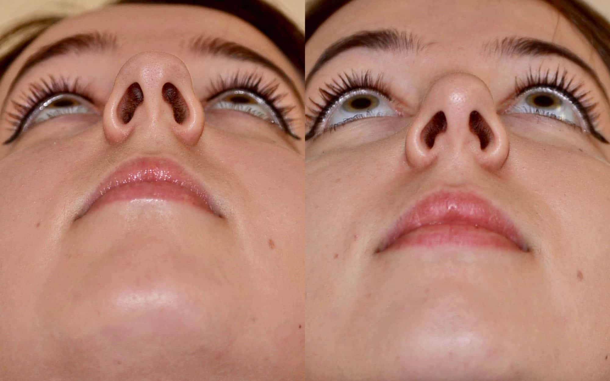 rhinoplasty before and after