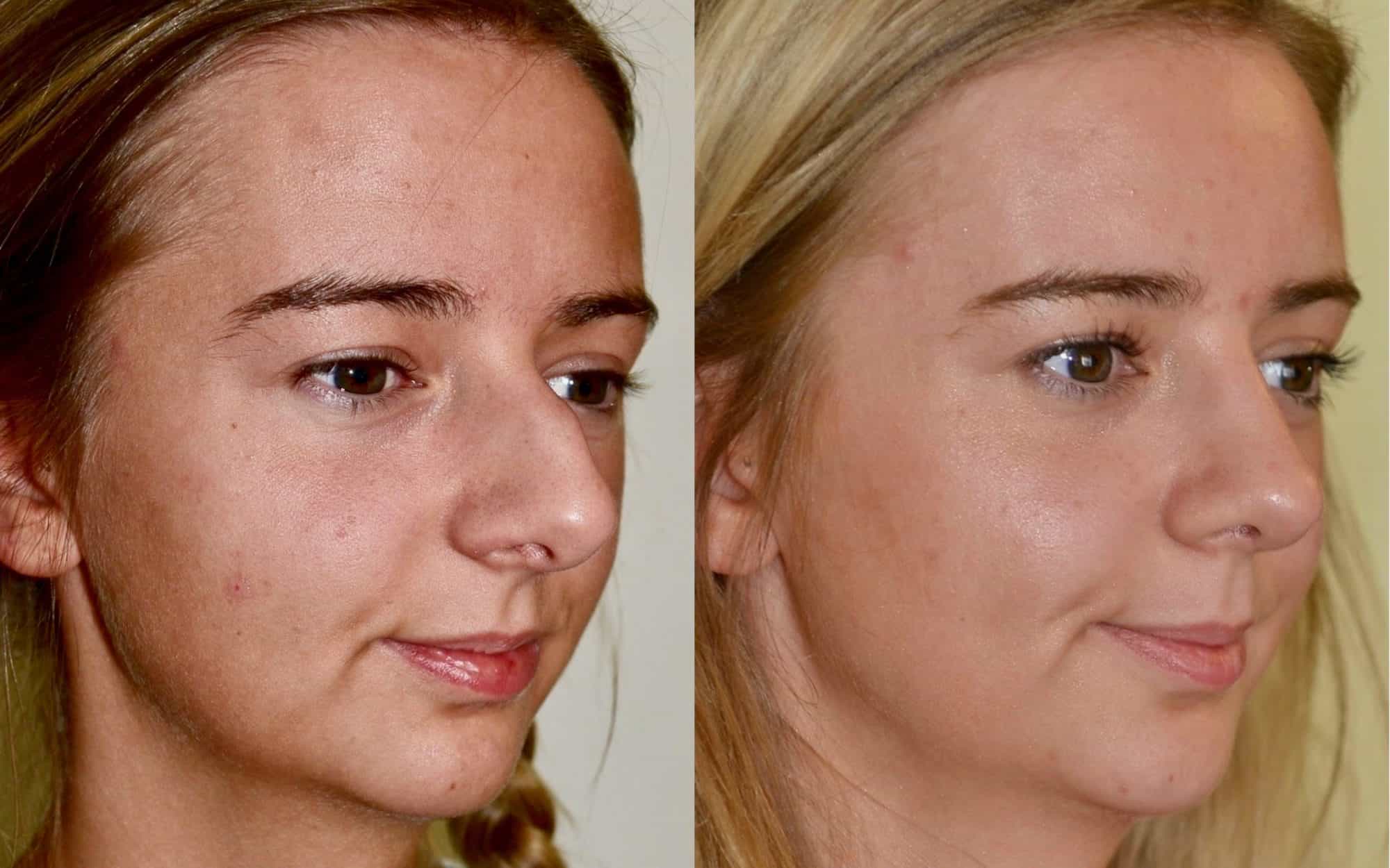 nose job photos uk