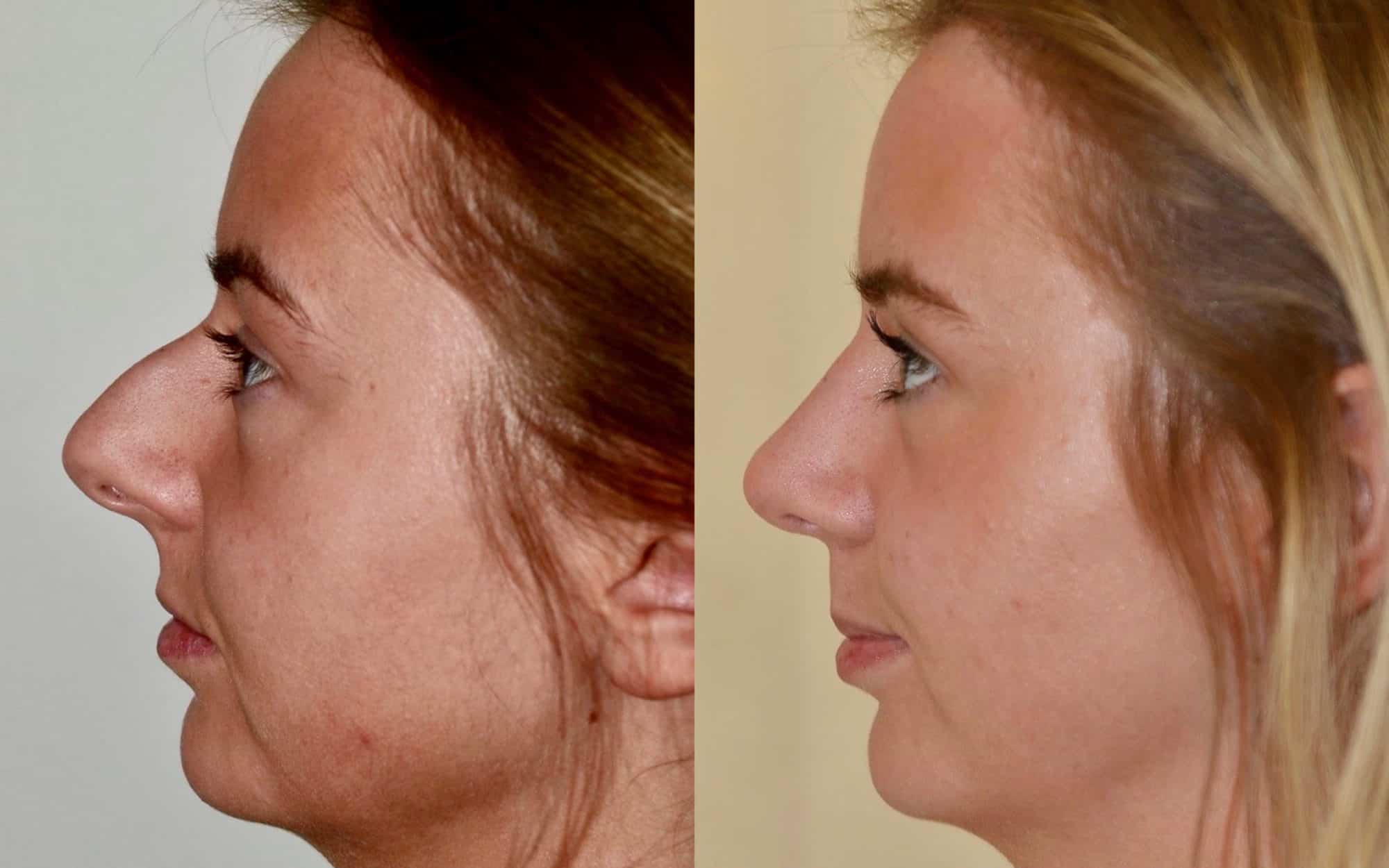 septo-rhinoplasty before and after