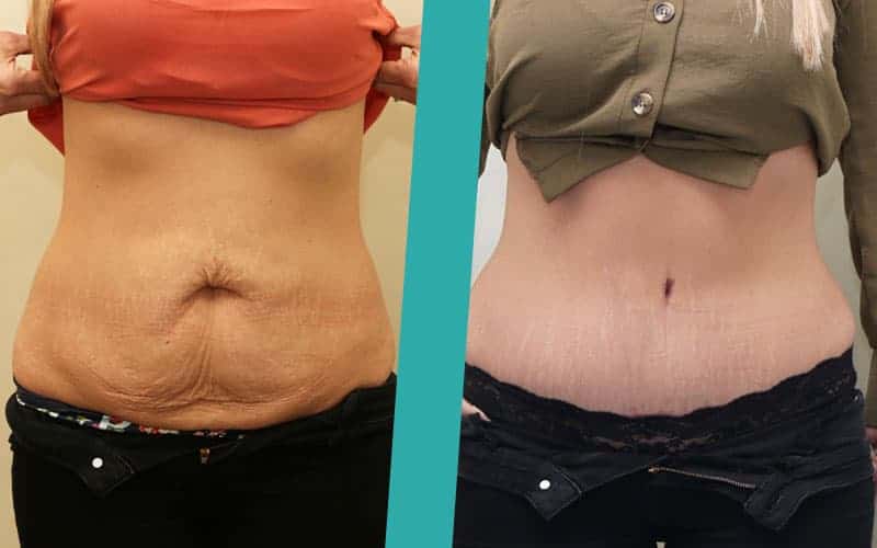 post-pregnancy-surgery-before-after-photos1 mummy makeover scotland