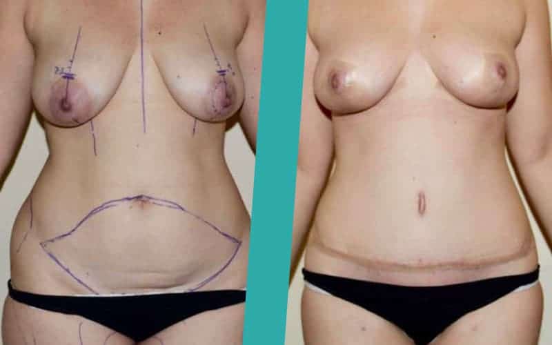 post-pregnancy-surgery-before-after-photos2 mummy makeover scotland