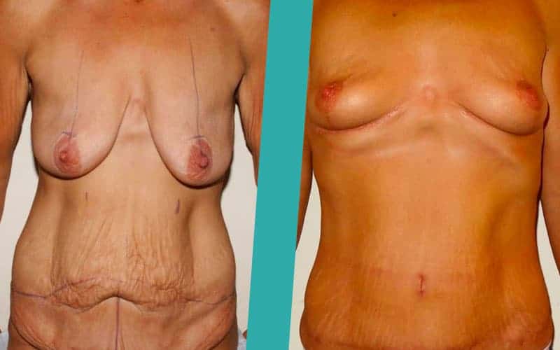 post-weight-loss-surgery-before-after-photos1 post weight loss surgery edinburgh