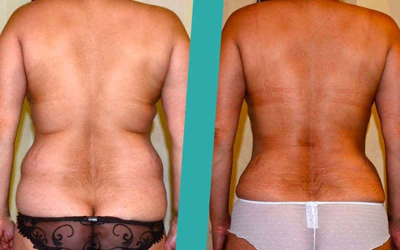 post-weight-loss-surgery-before-after-photos2 post weight loss liposuction