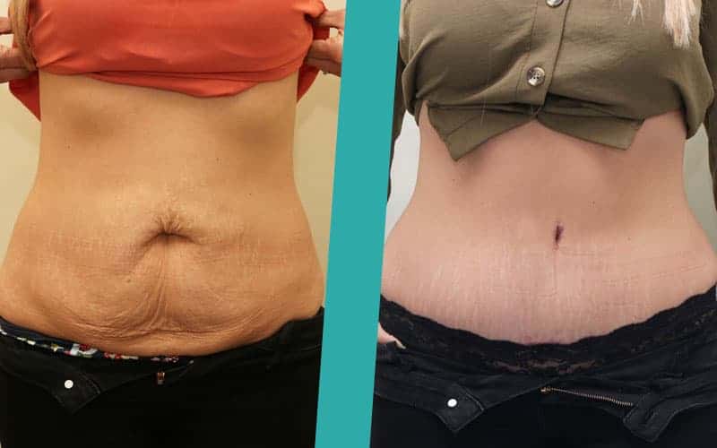 tummy tuck surgery before after photos2