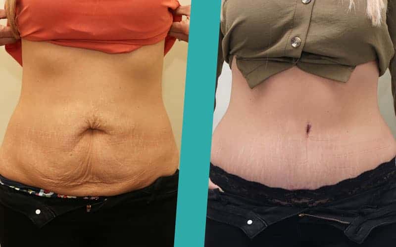 tummy tuck recovery pain tummy tuck recovery pain