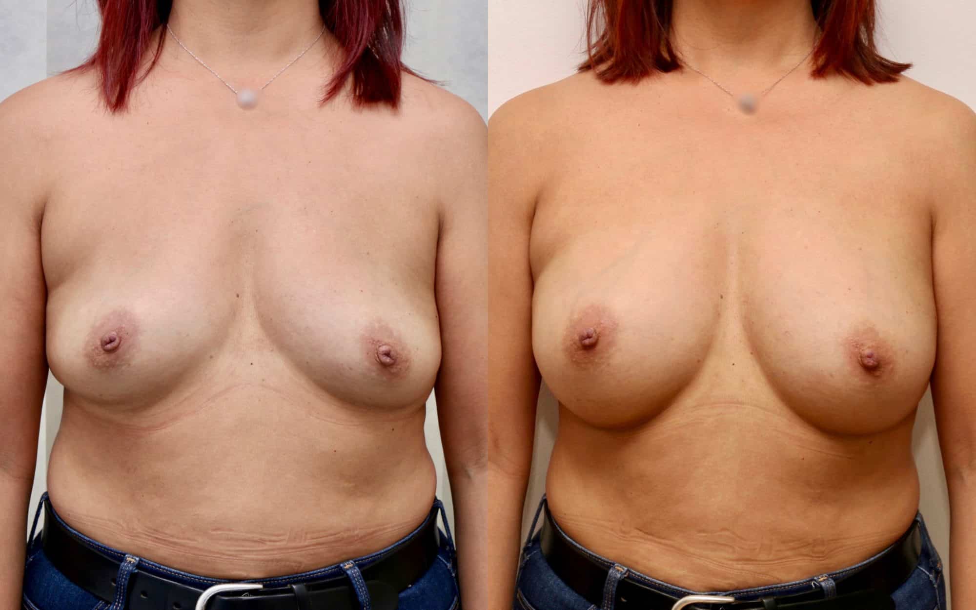 Natural 275cc breast augmentation