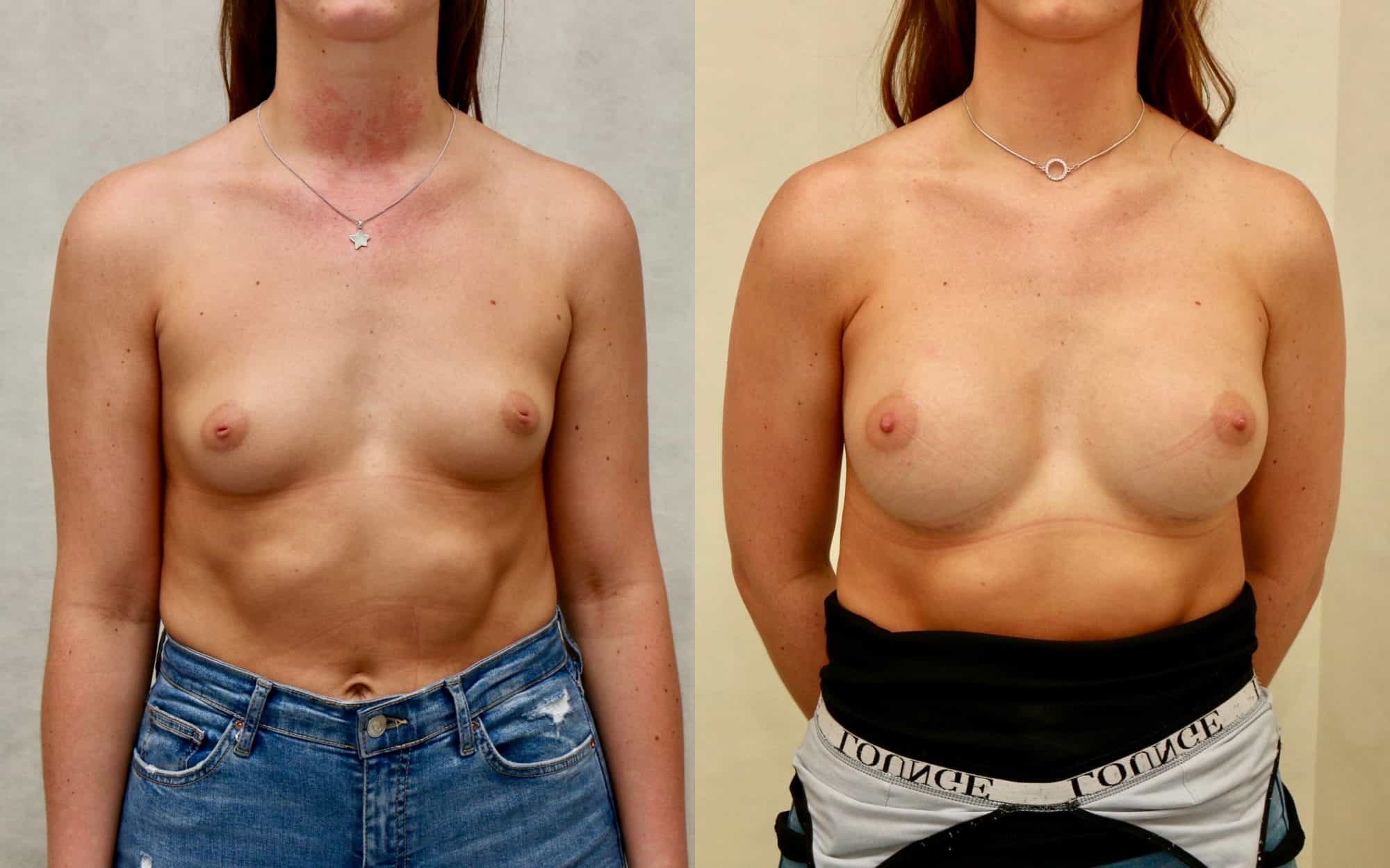 breast augmentation edinburgh