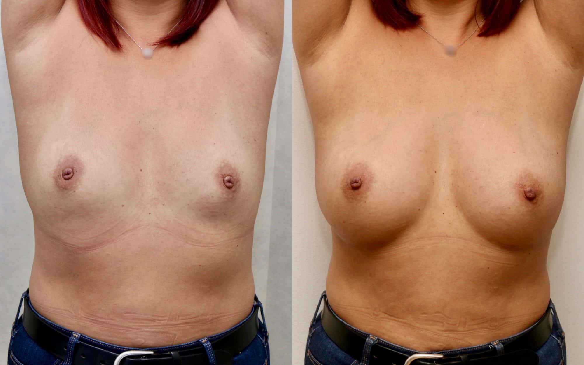 Natural 275cc breast augmentation