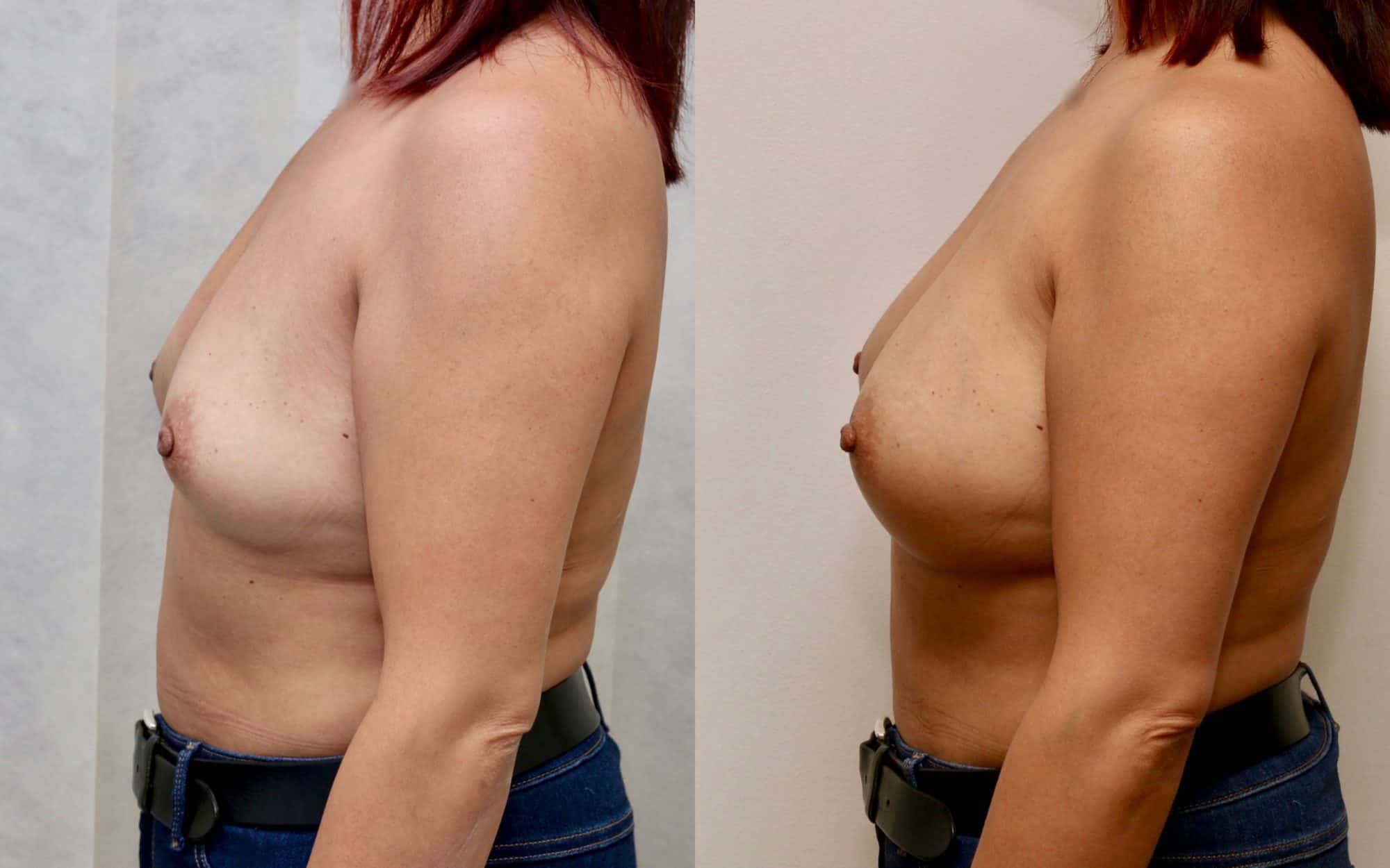 Natural 275cc breast augmentation