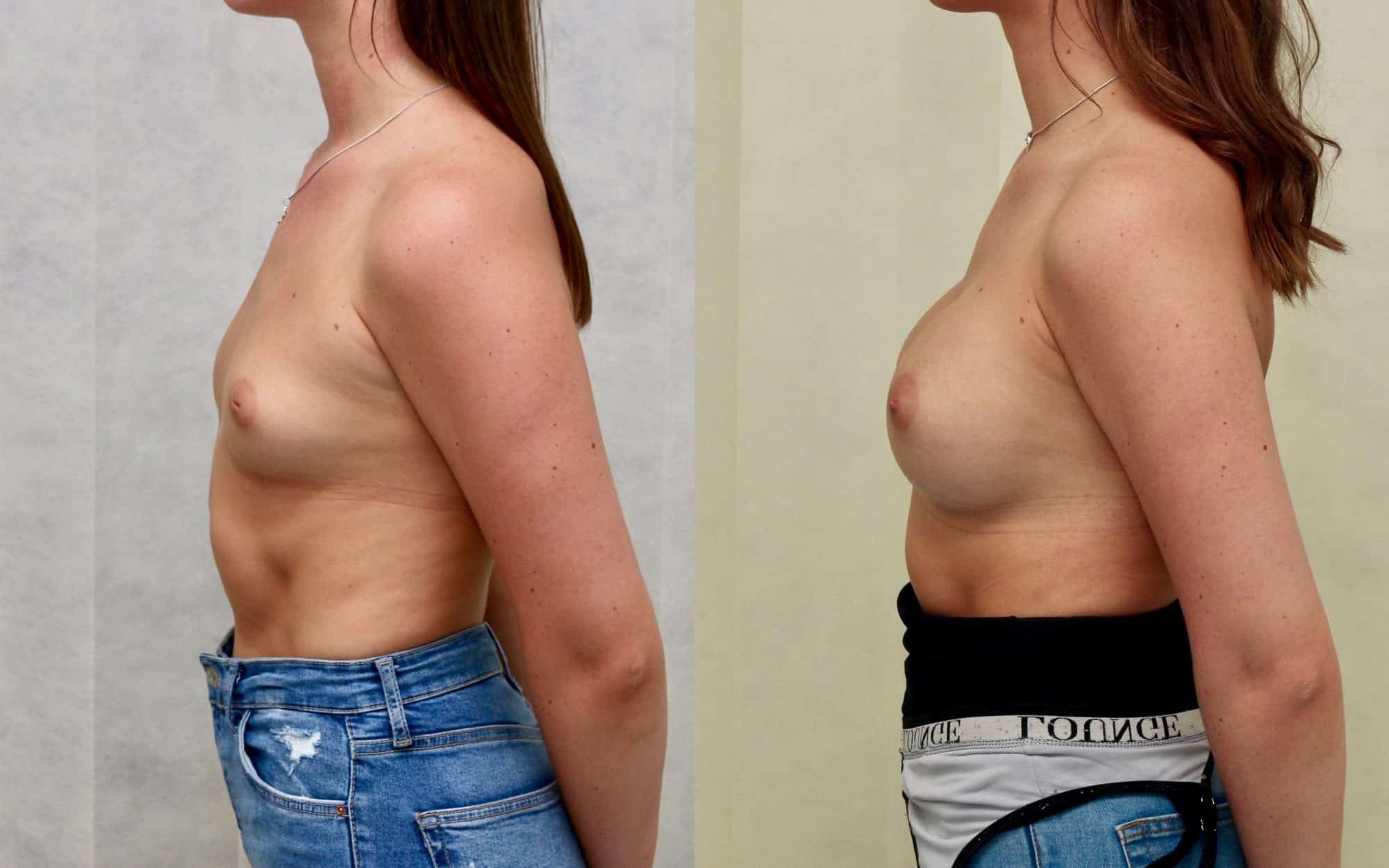 345cc round under muscle breast implants