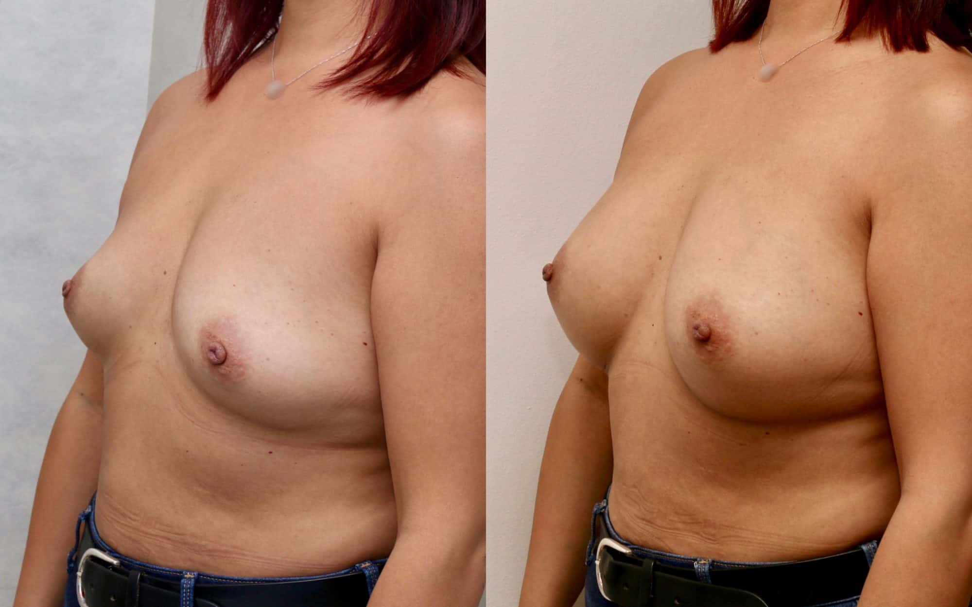 Natural 275cc breast augmentation