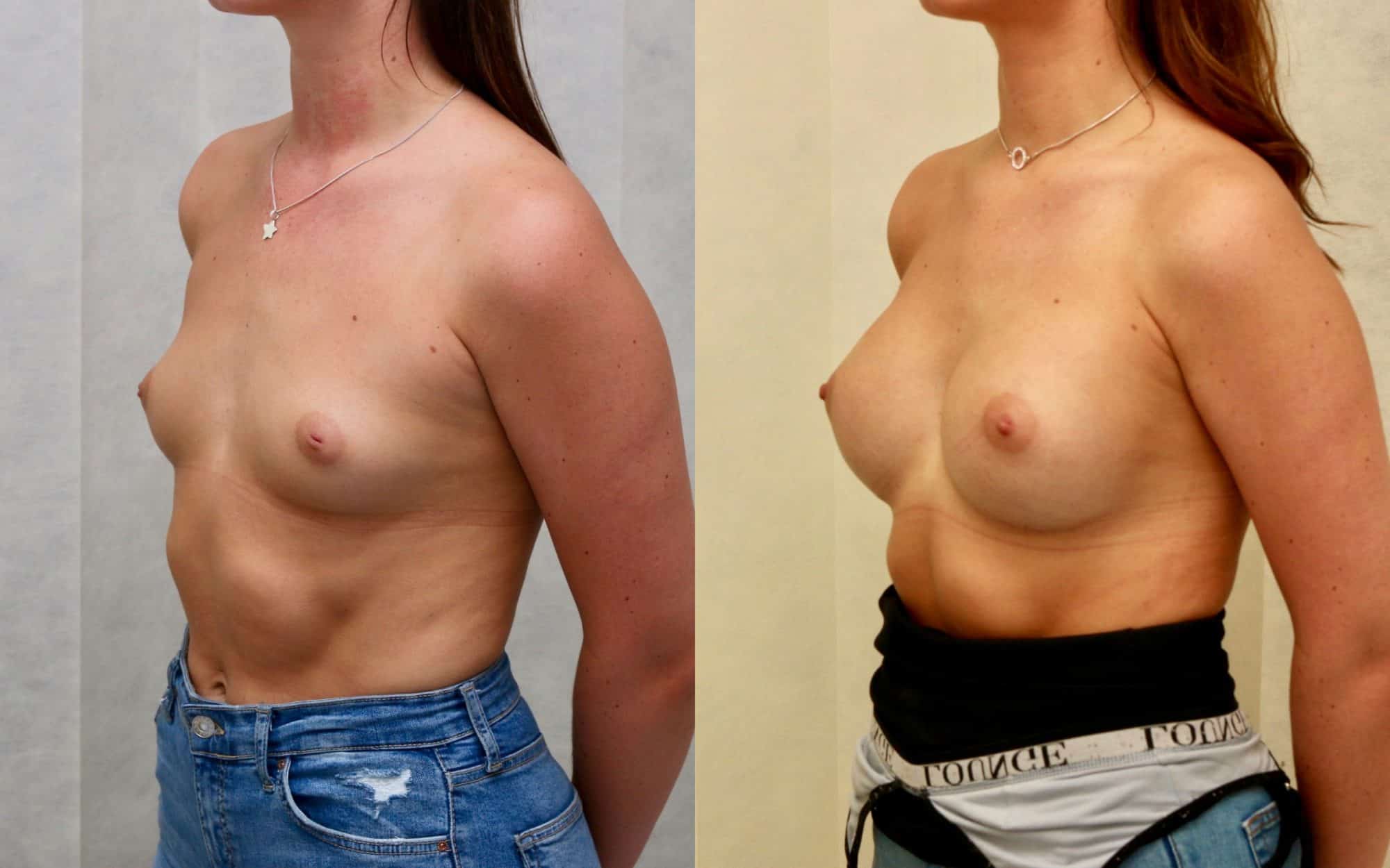 345cc round under muscle breast implants