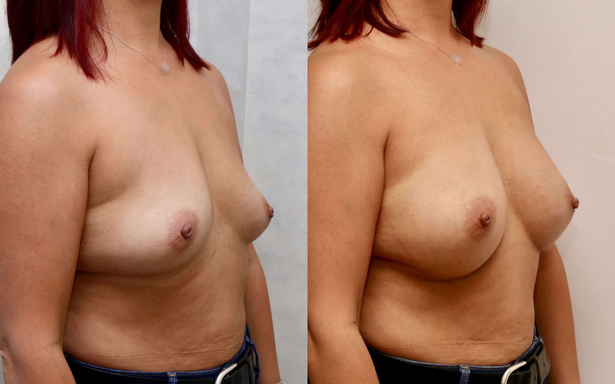 Natural 275cc breast augmentation
