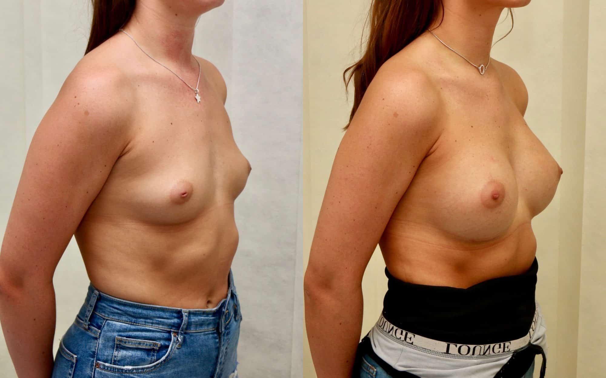 345cc round under muscle breast implants