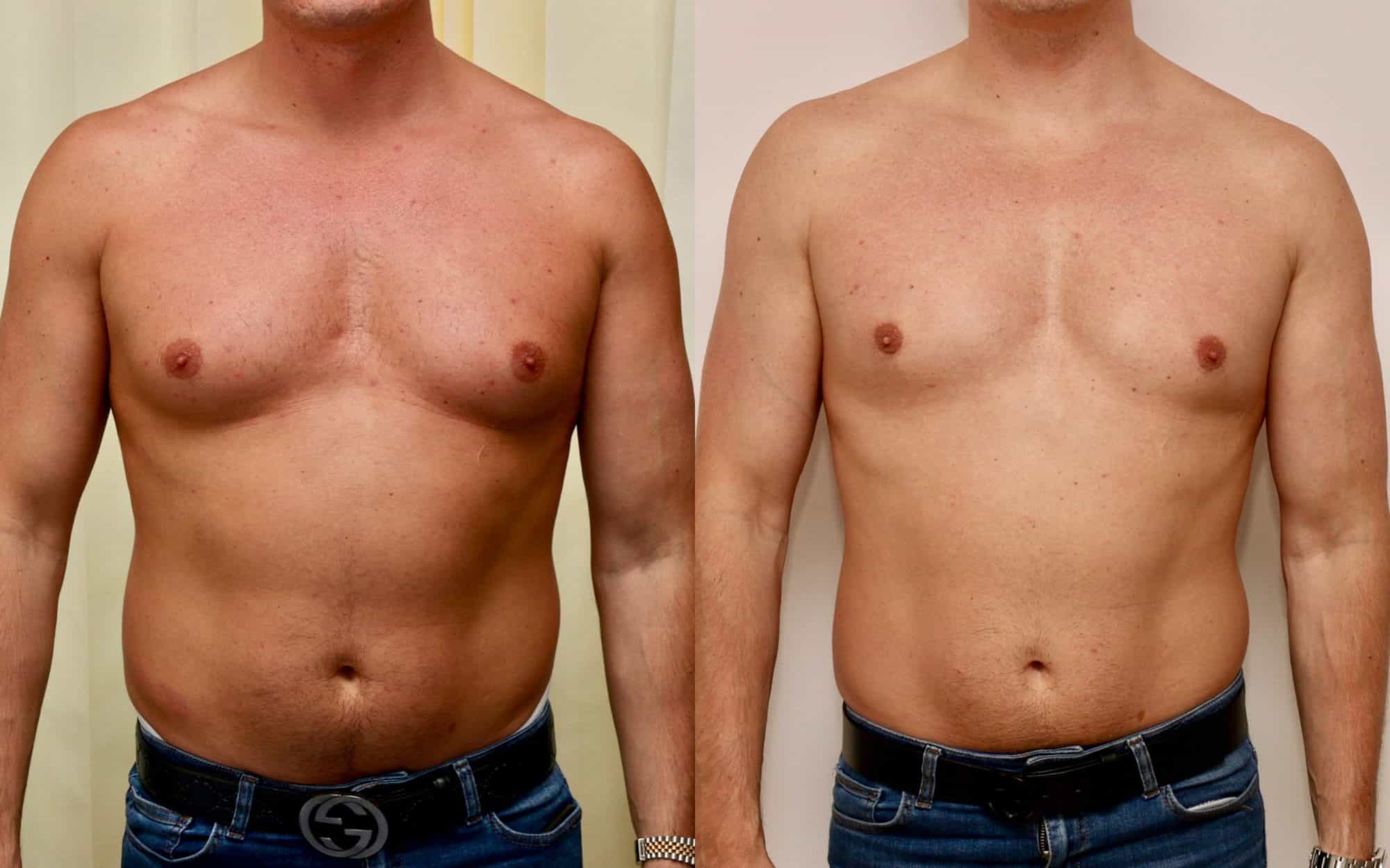 Gynecomastia before and after