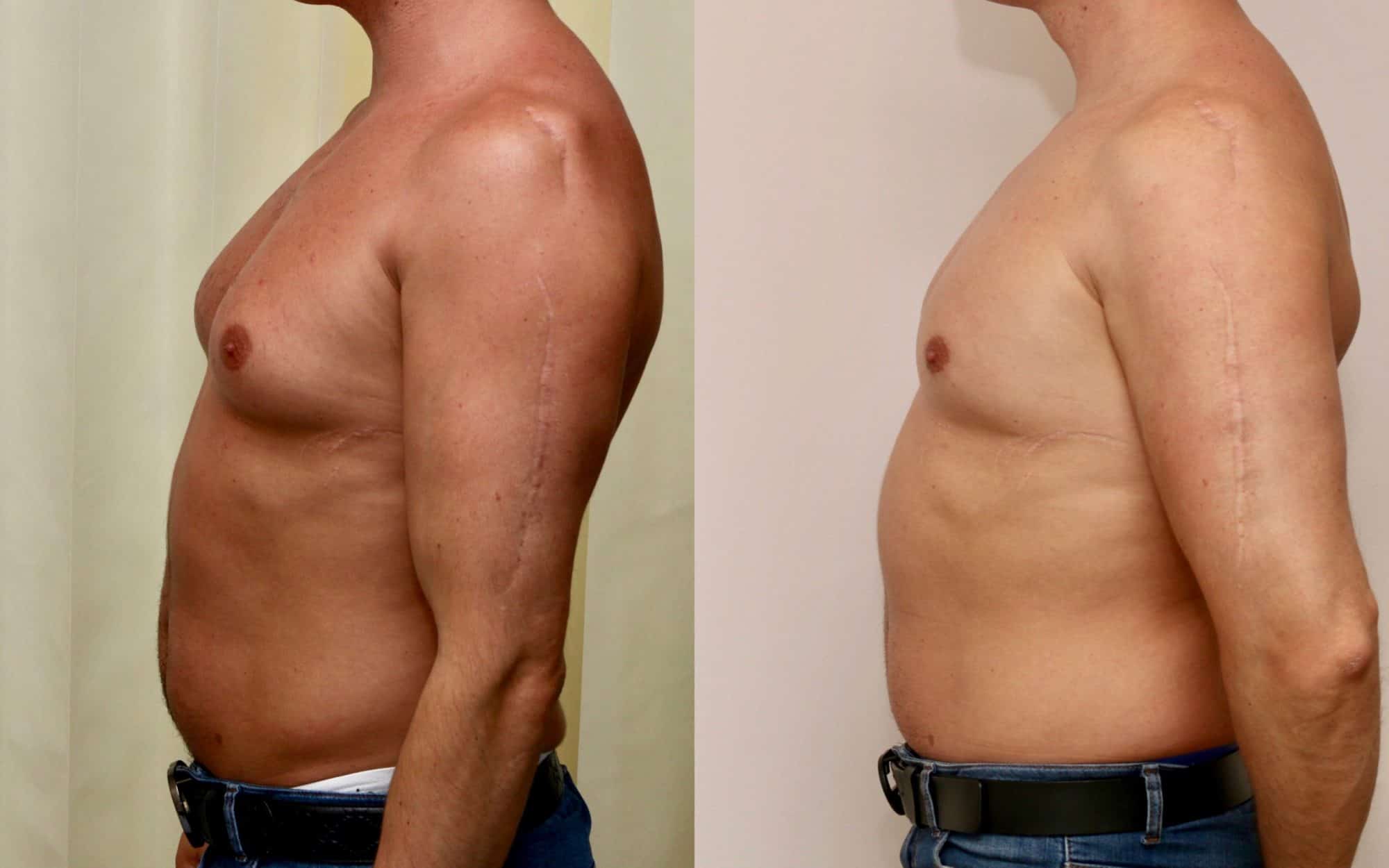 Gynecomastia before and after