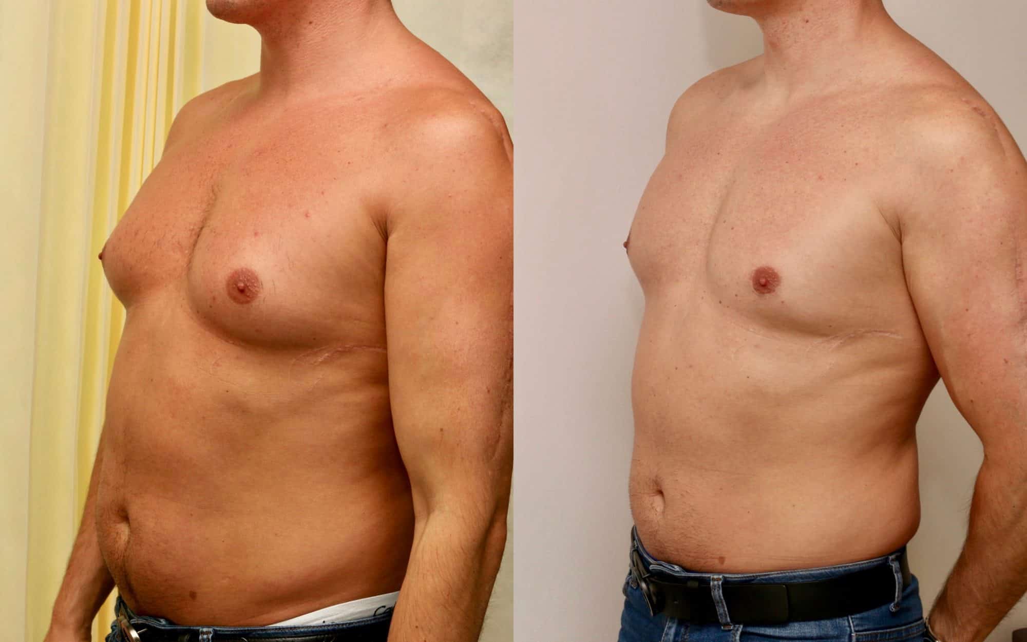 Gynecomastia before and after