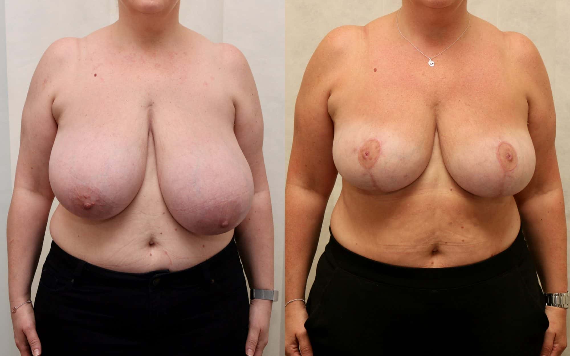 Large breast reduction with asymmetry before and after