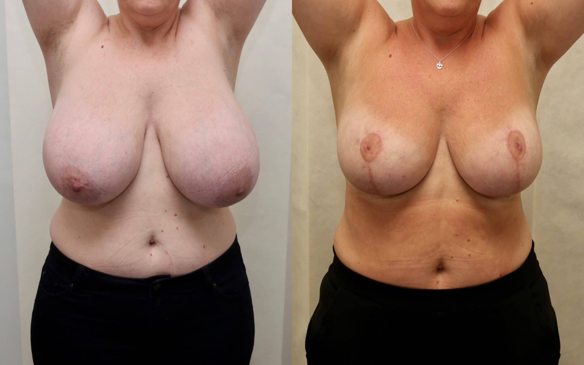 Large breast reduction with asymmetry before and after