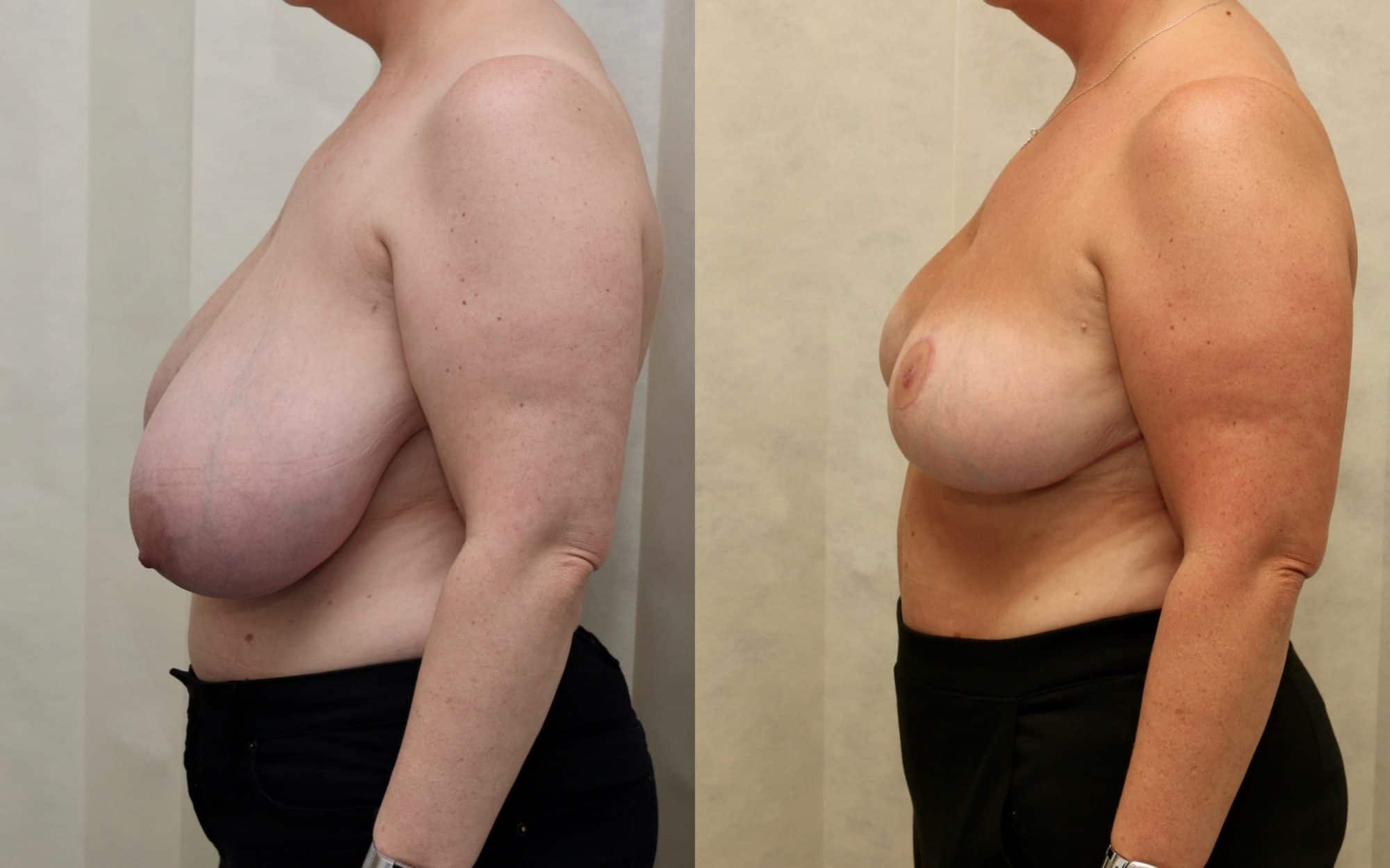 Large breast reduction with asymmetry before and after