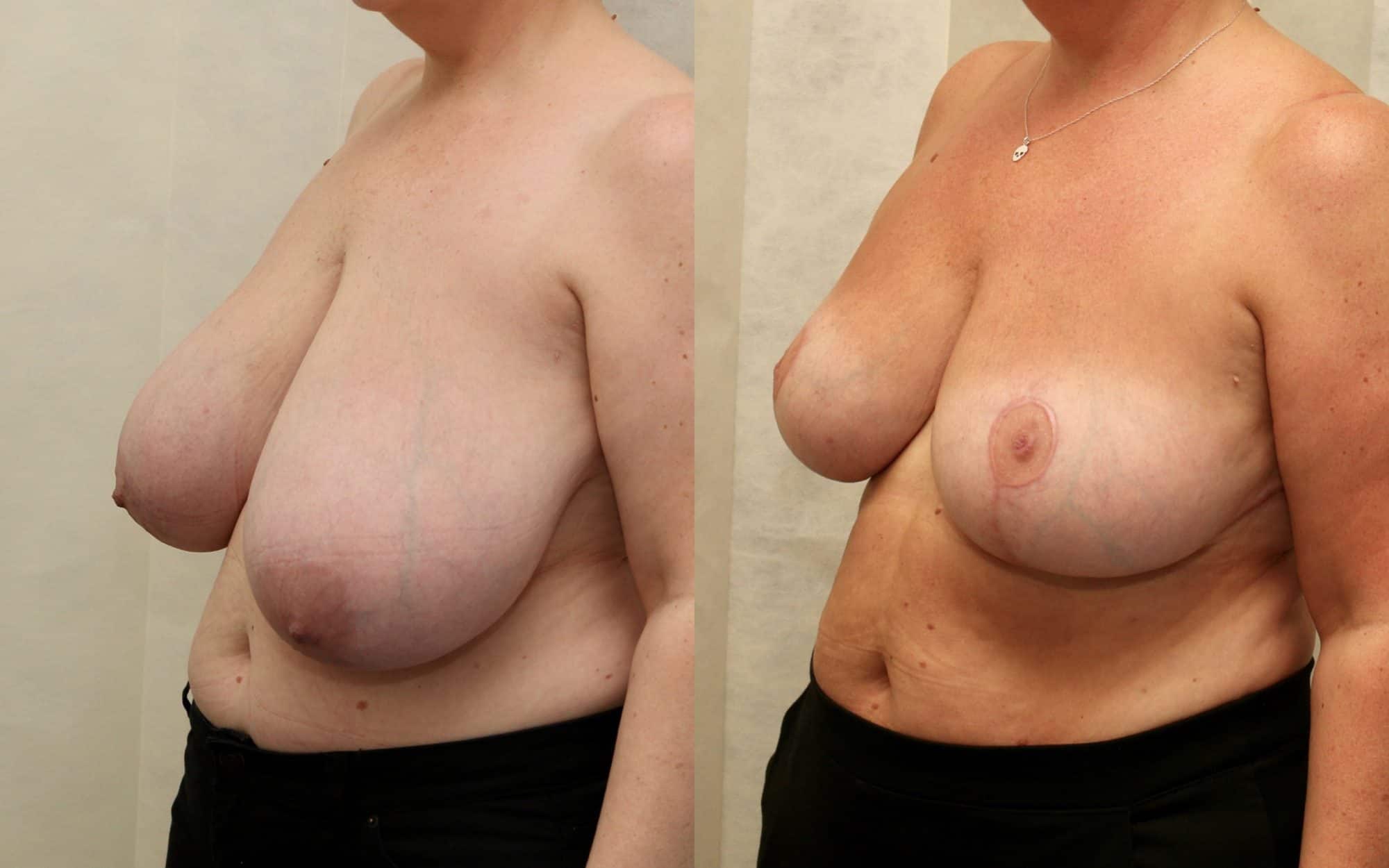 Large breast reduction with asymmetry before and after