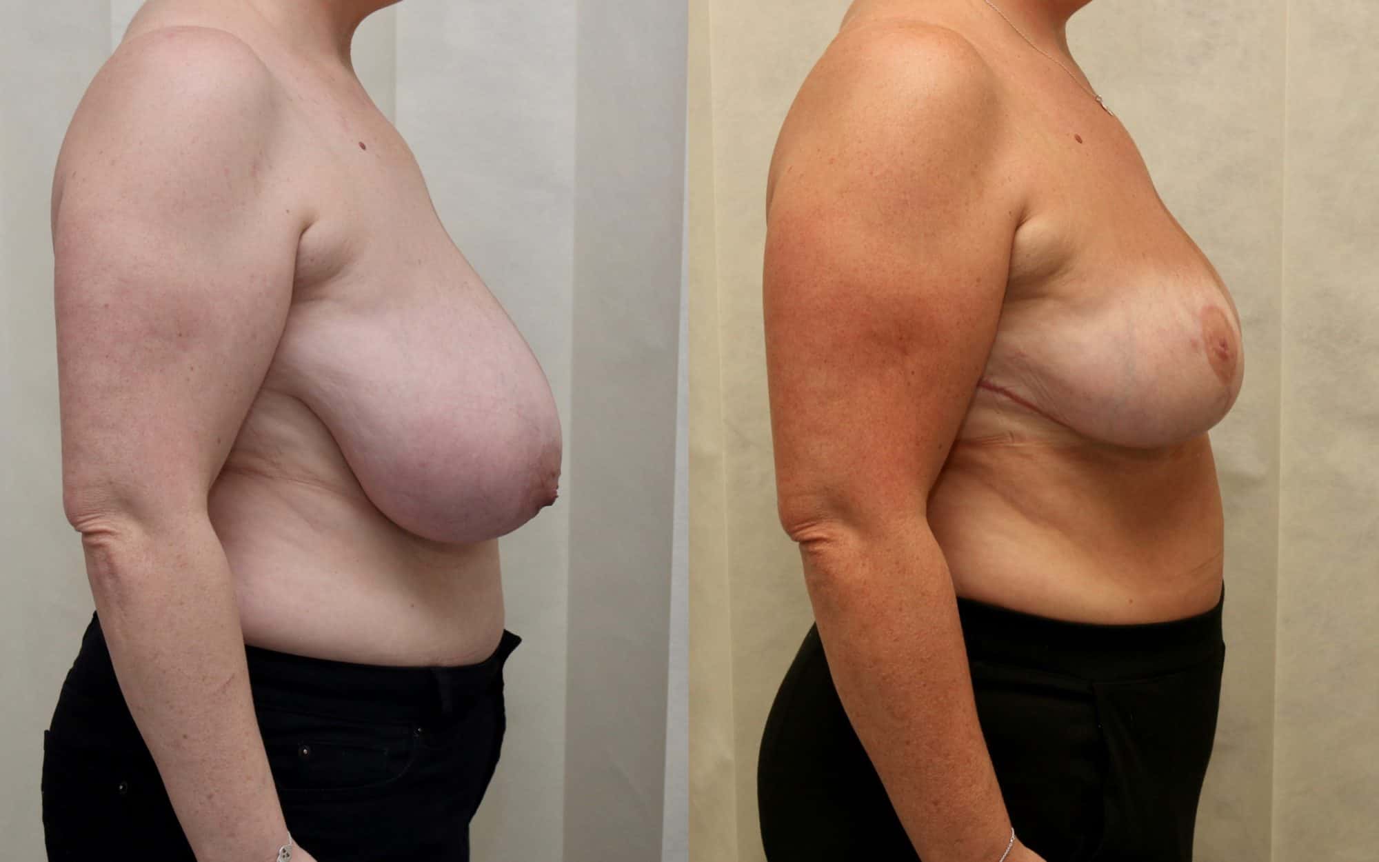 Large breast reduction with asymmetry before and after