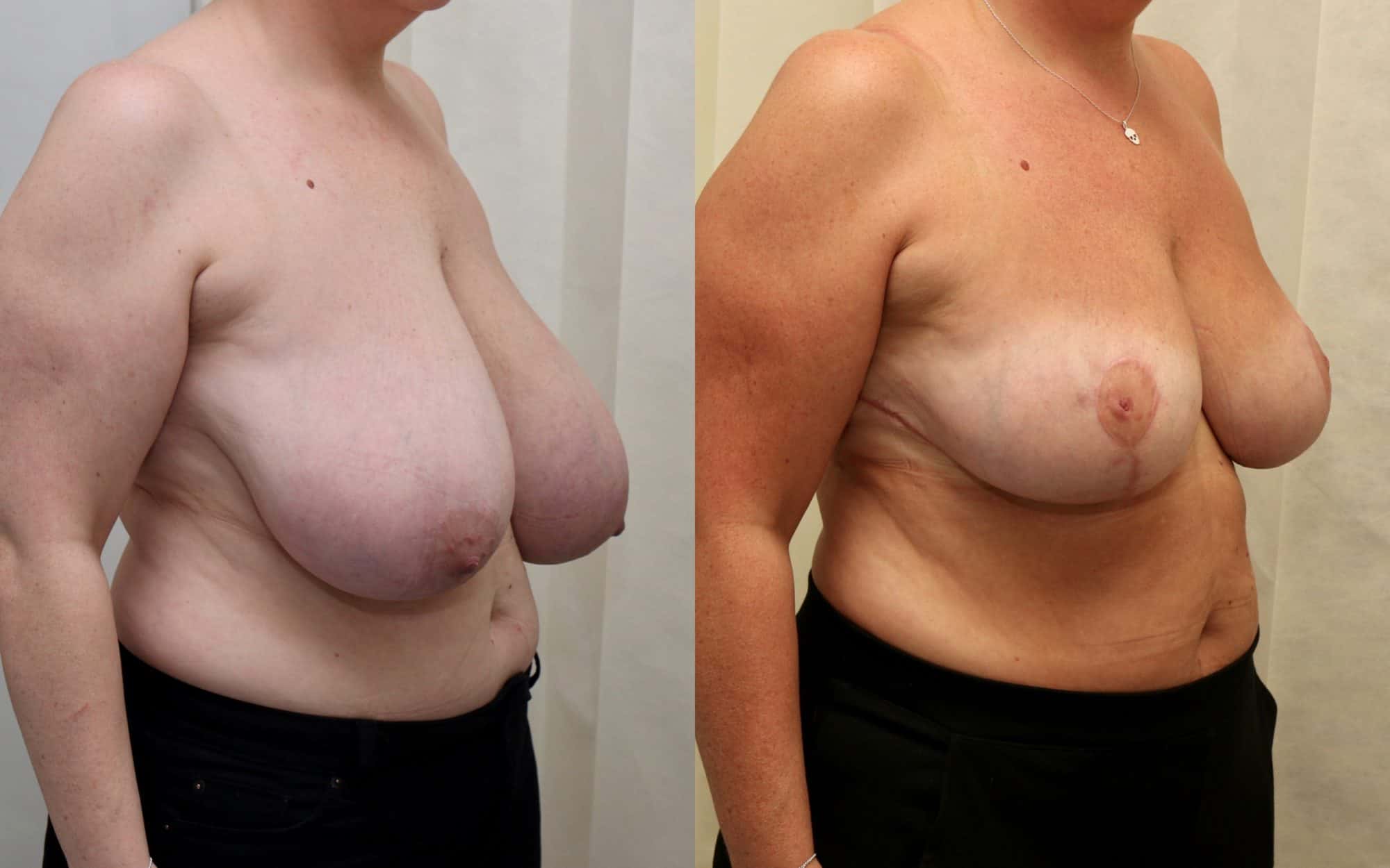 Large breast reduction with asymmetry before and after