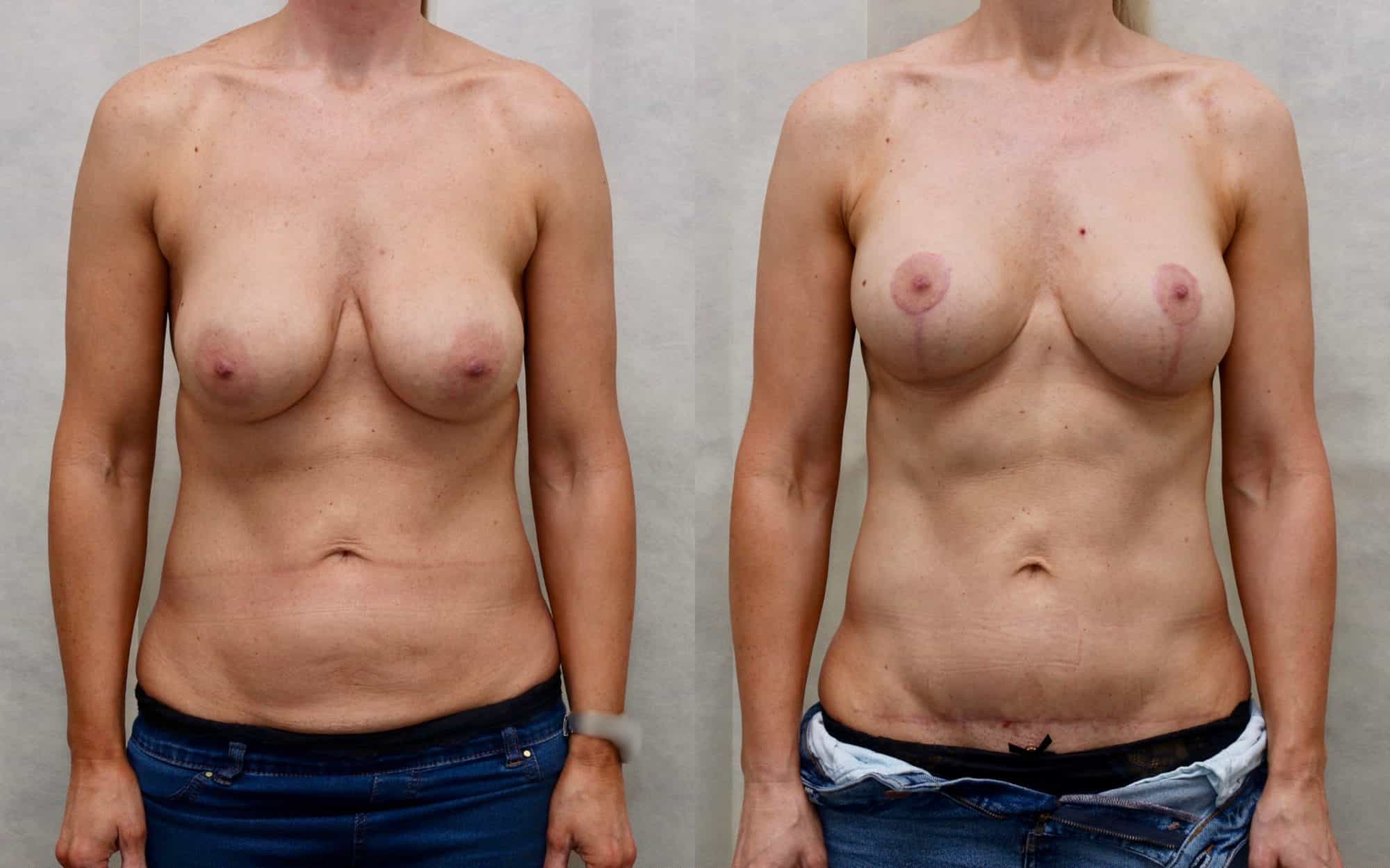 revision breast before and after