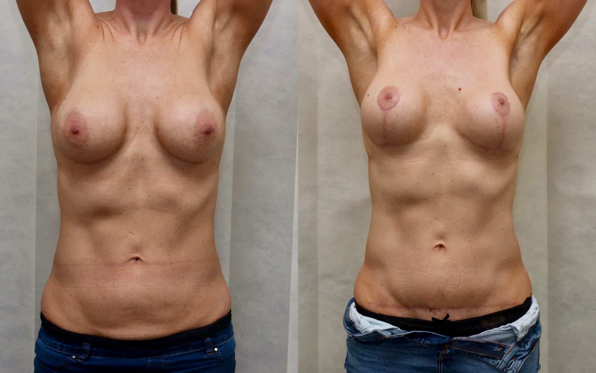 revision breast before and after
