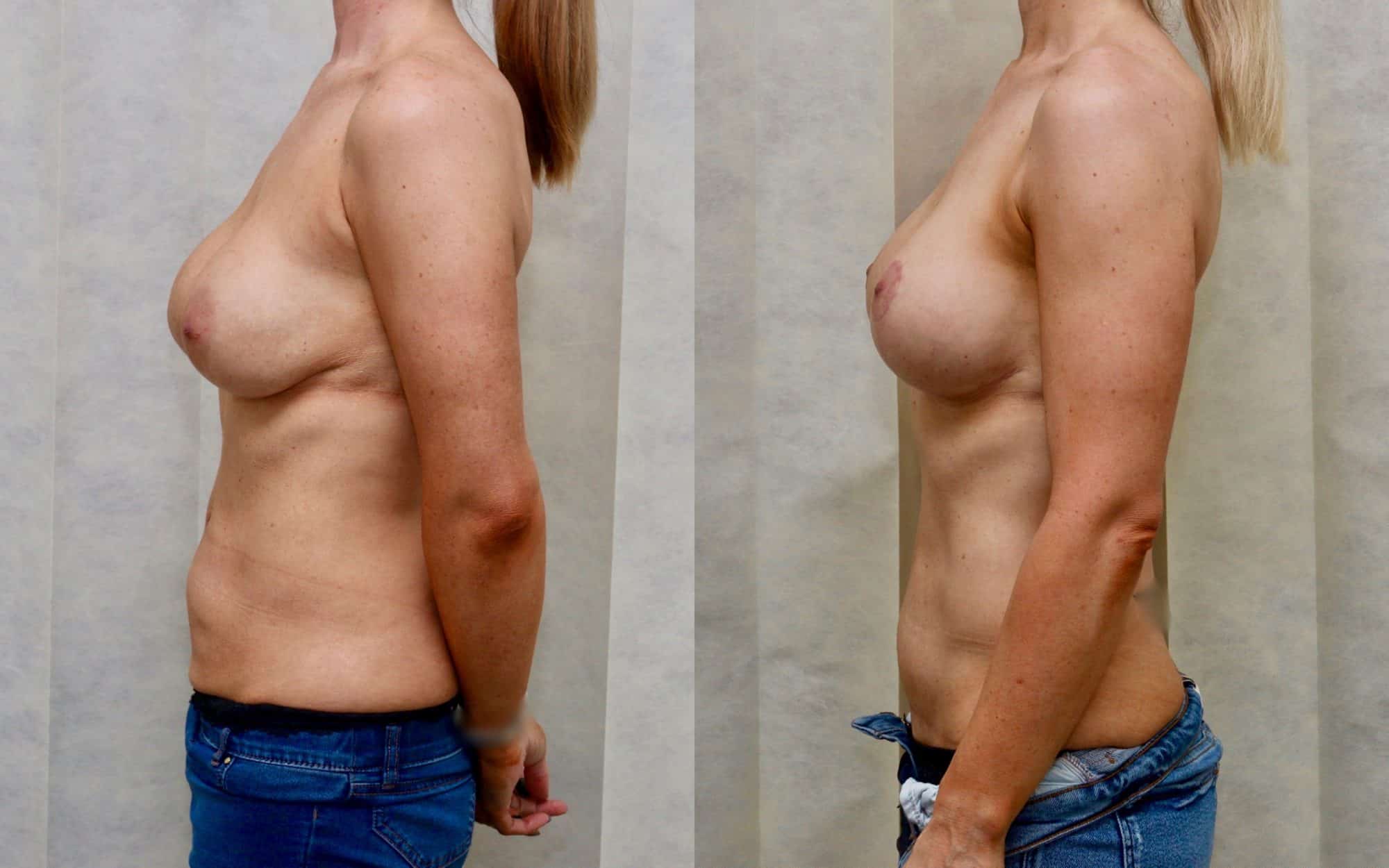 revision breast before and after