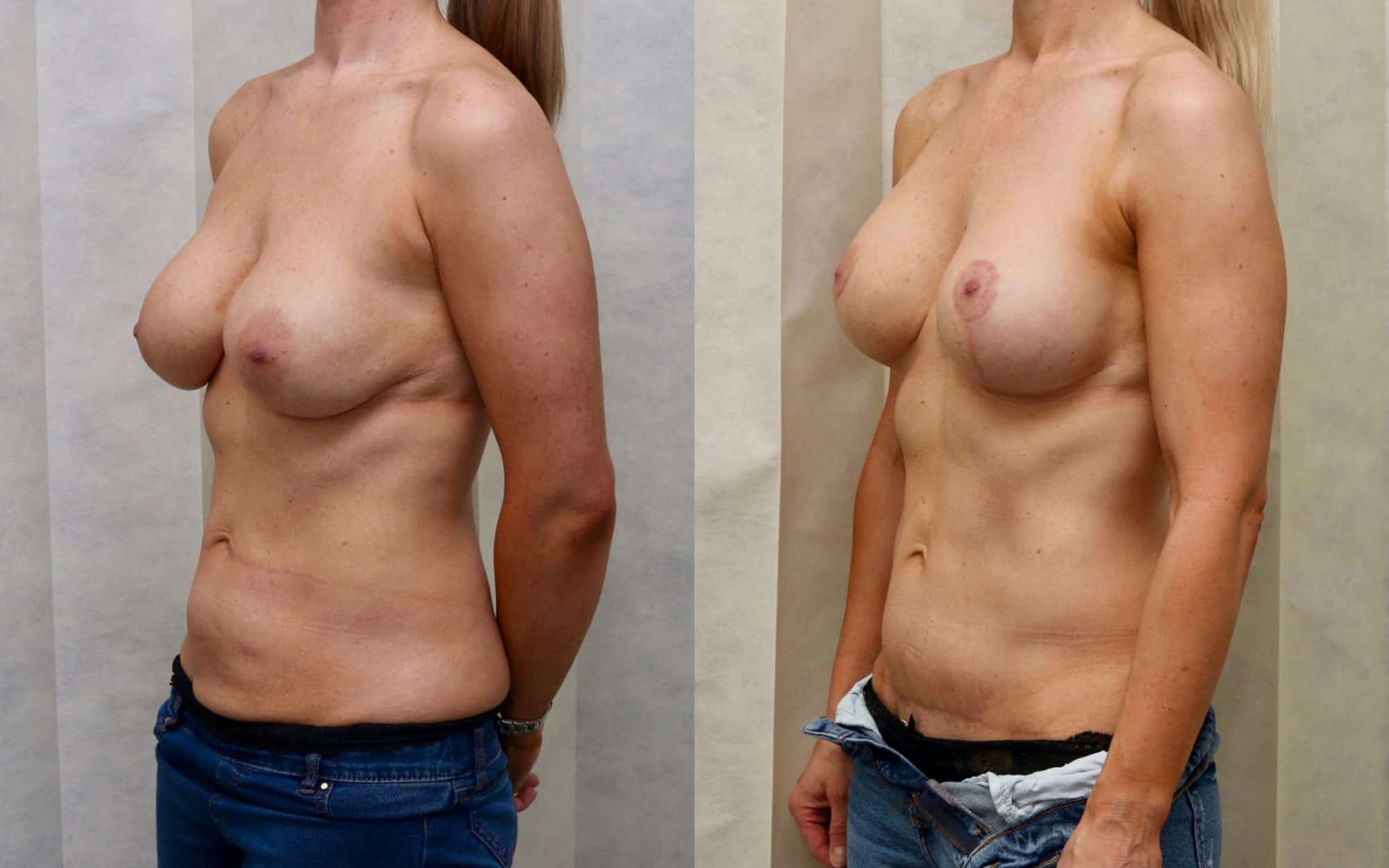 revision breast before and after