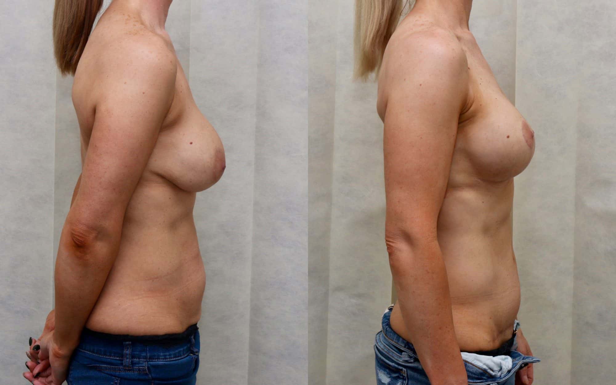 revision breast before and after