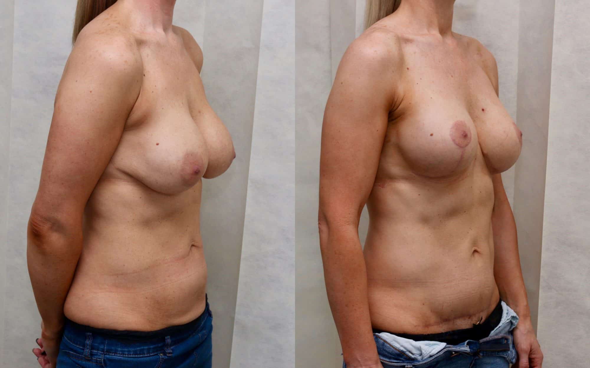 revision breast before and after