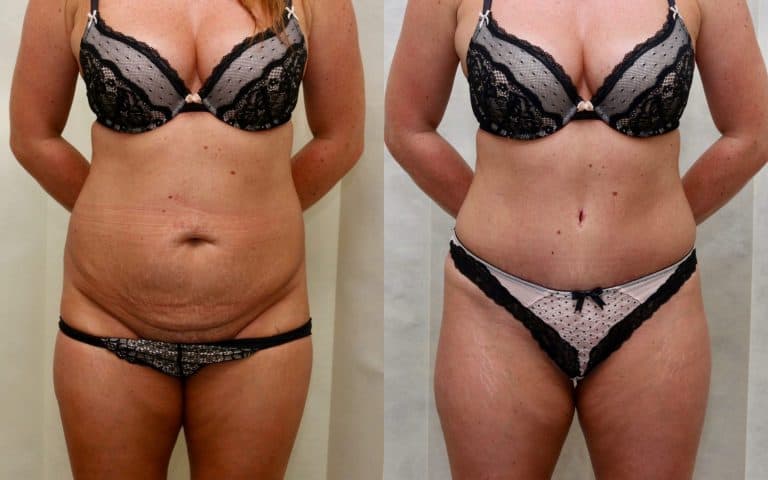 Tummy tuck before and after, case 20, photo 1 of 7