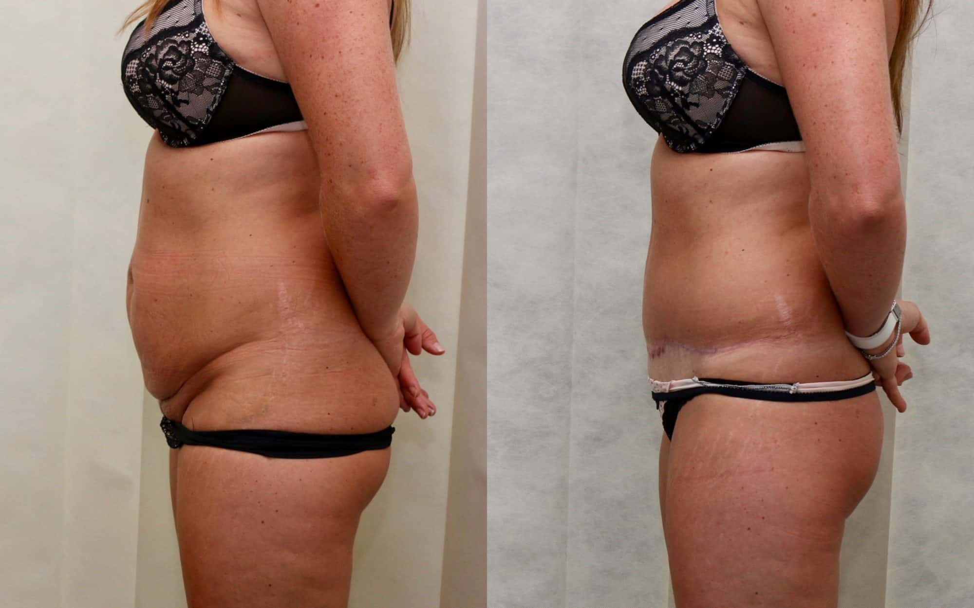 tummy tuck before and after