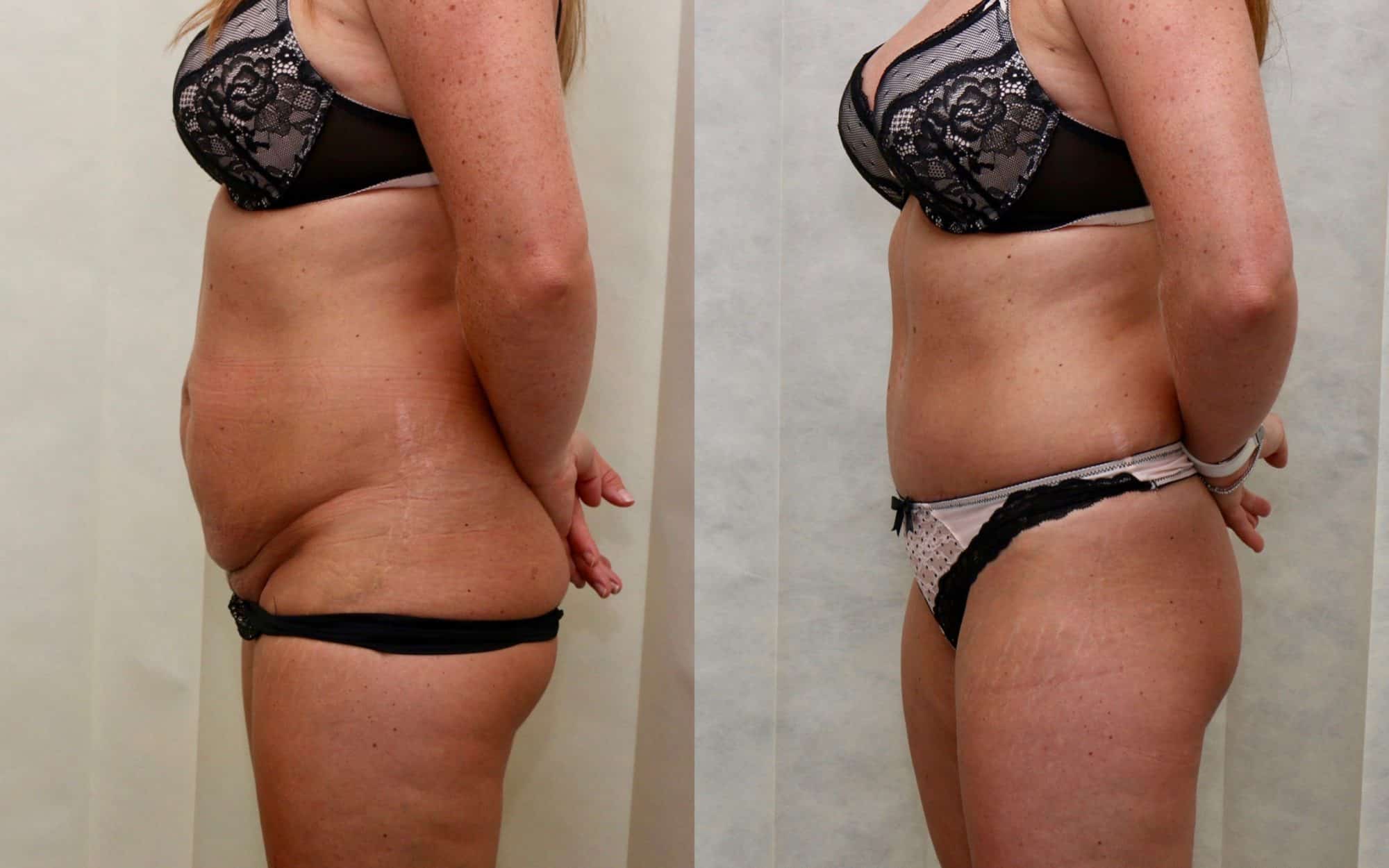 tummy tuck before and after