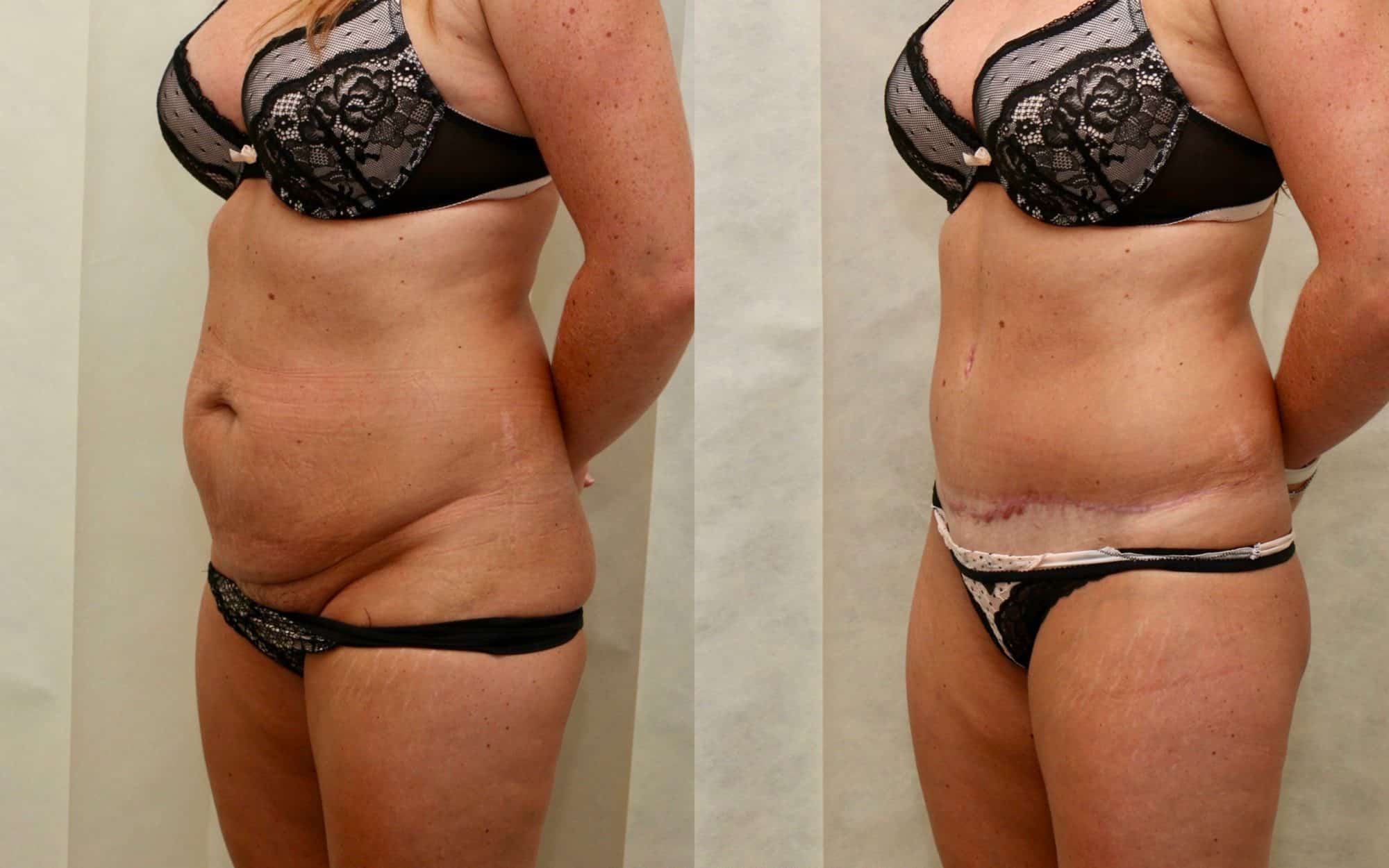 tummy tuck before and after