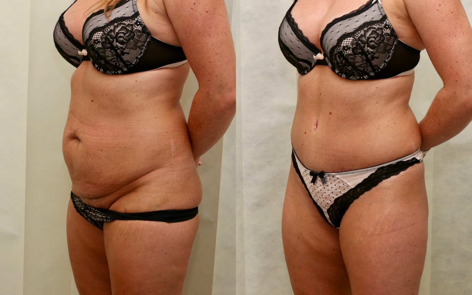 tummy tuck before and after