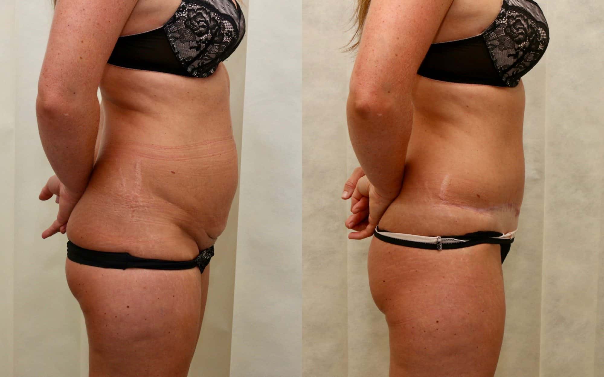 tummy tuck before and after