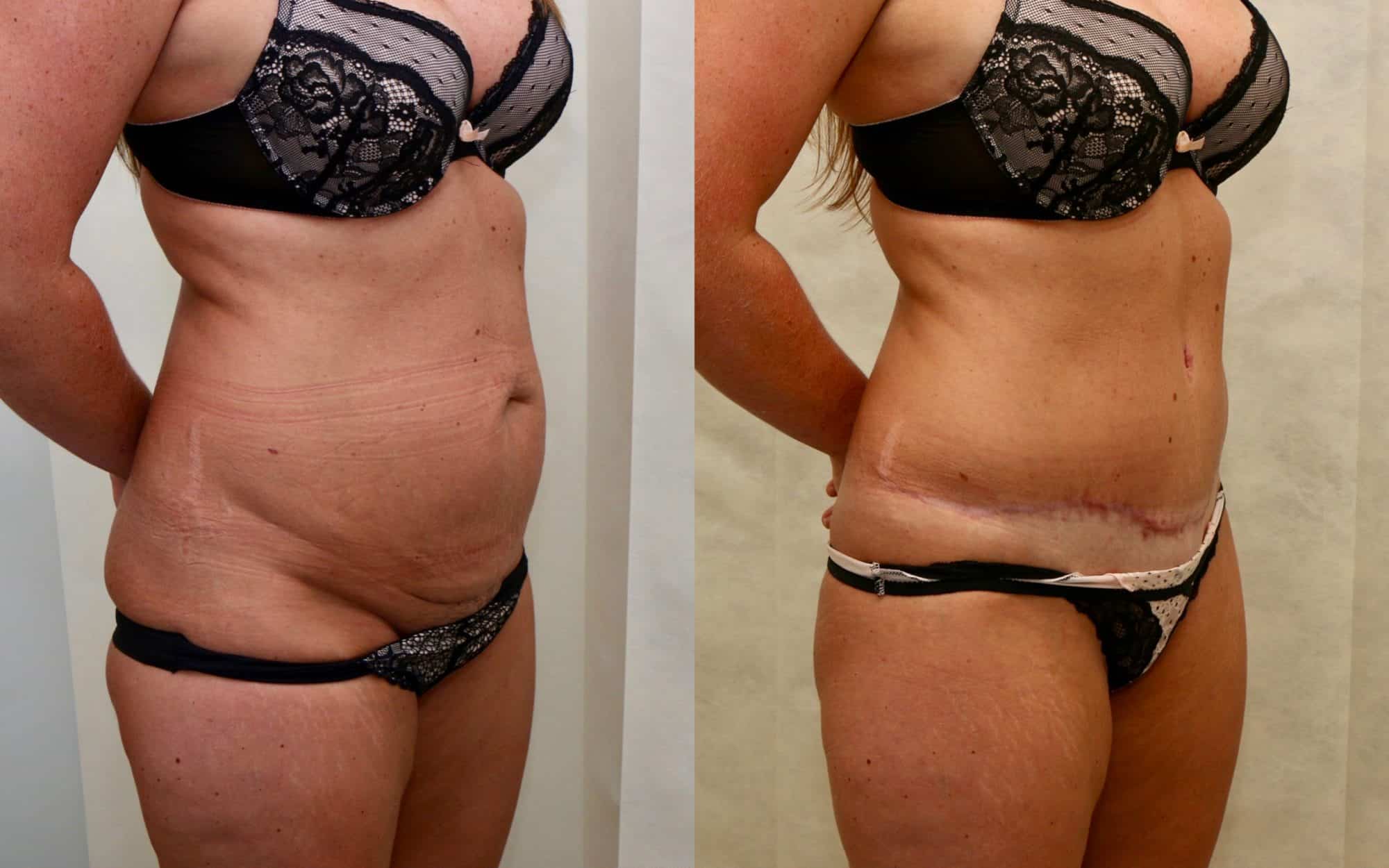 tummy tuck before and after