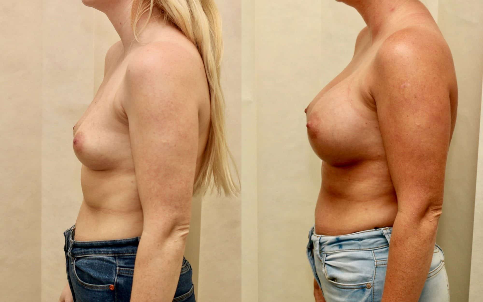 breast implants edinburgh