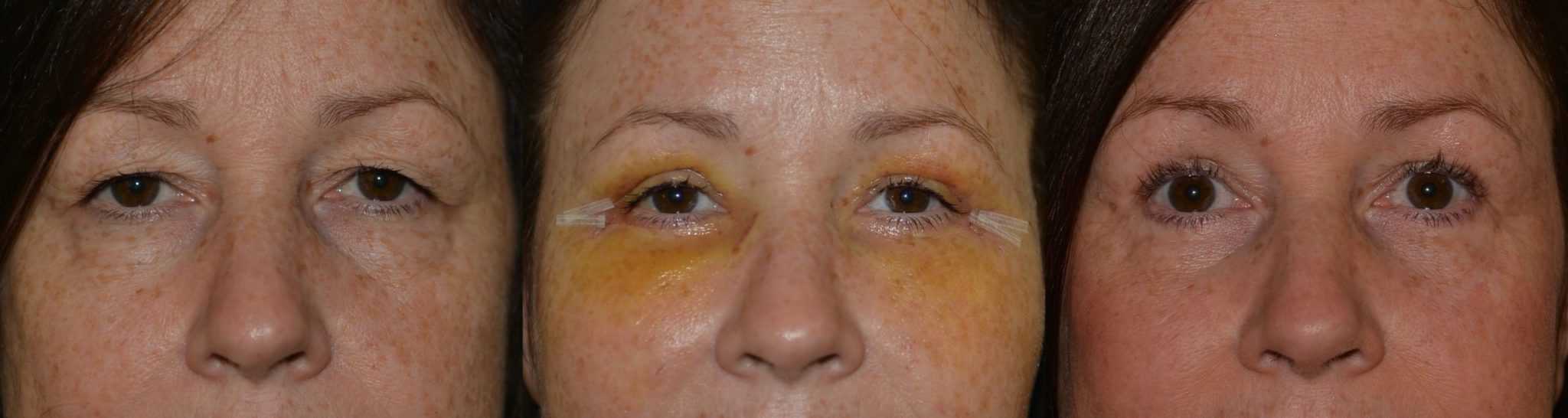 Eyelid surgery with fat transfer