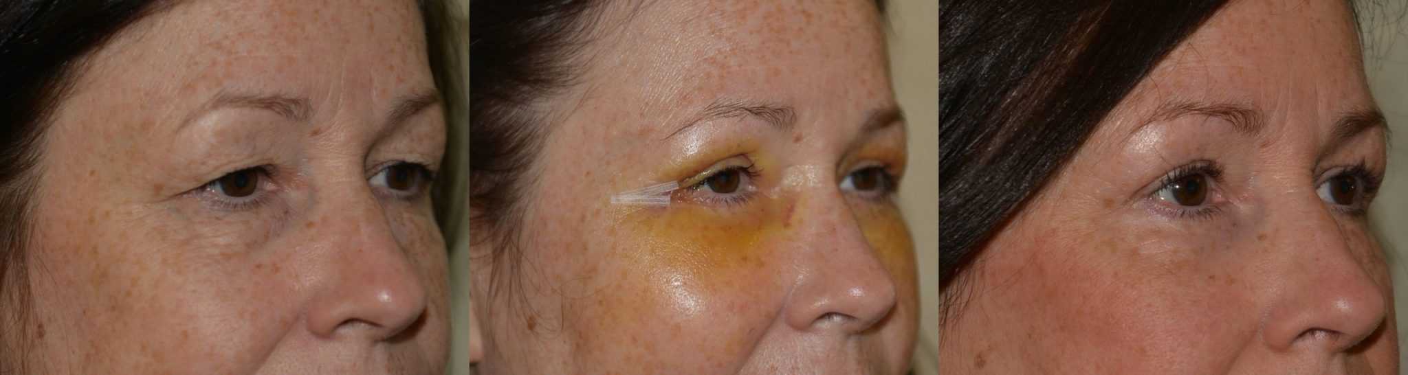 Eyelid surgery with fat transfer
