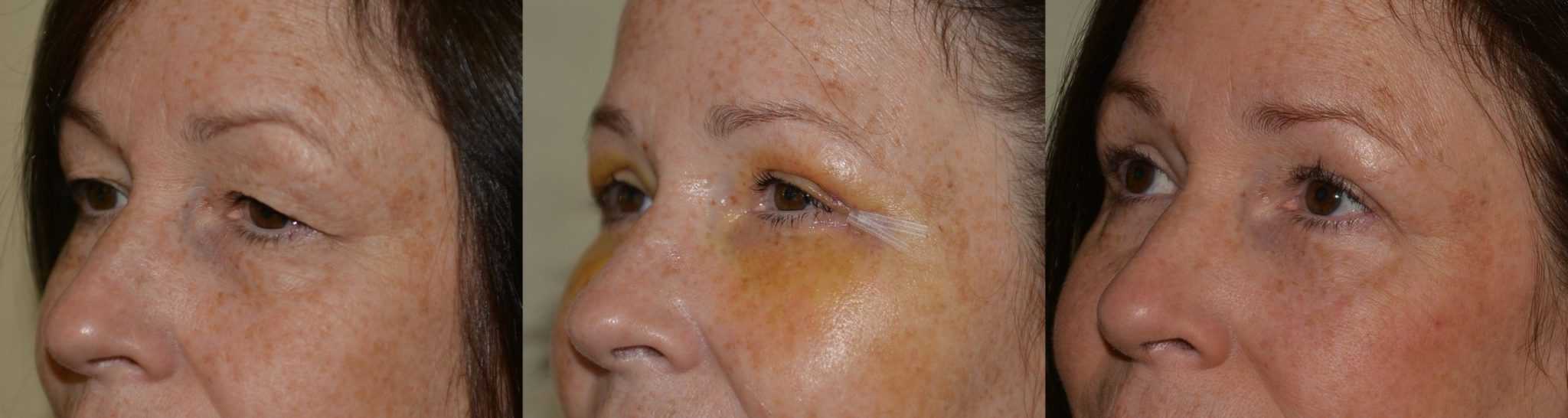 Eyelid surgery with fat transfer