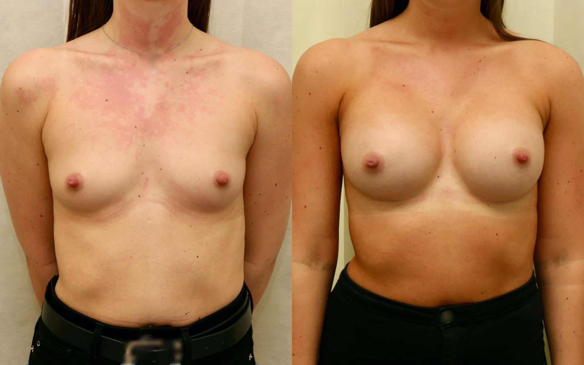 breast implants before and after