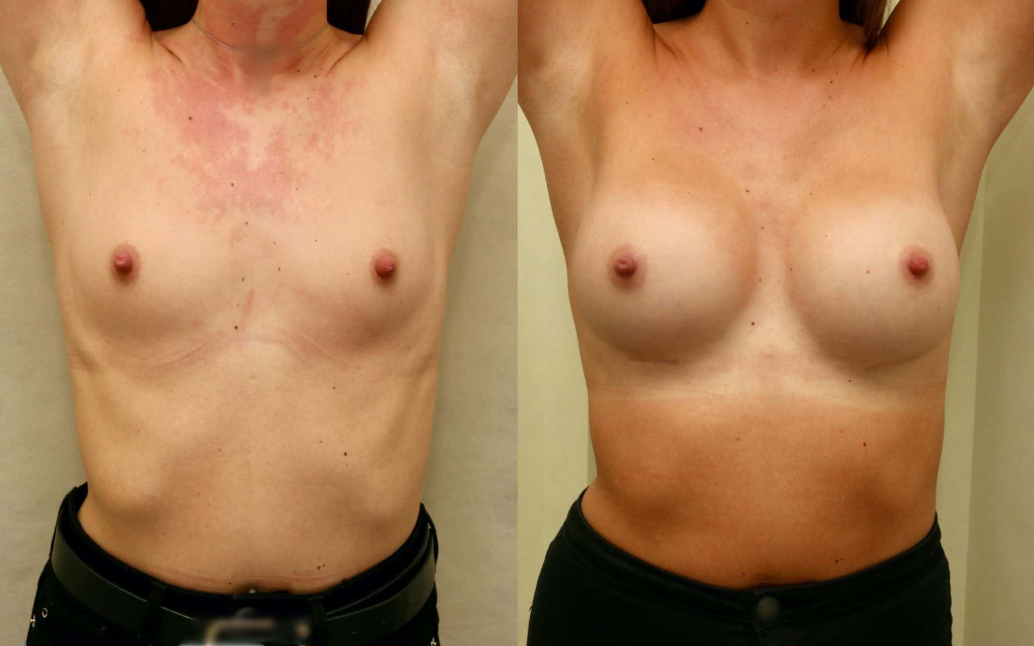 breast implants before and after