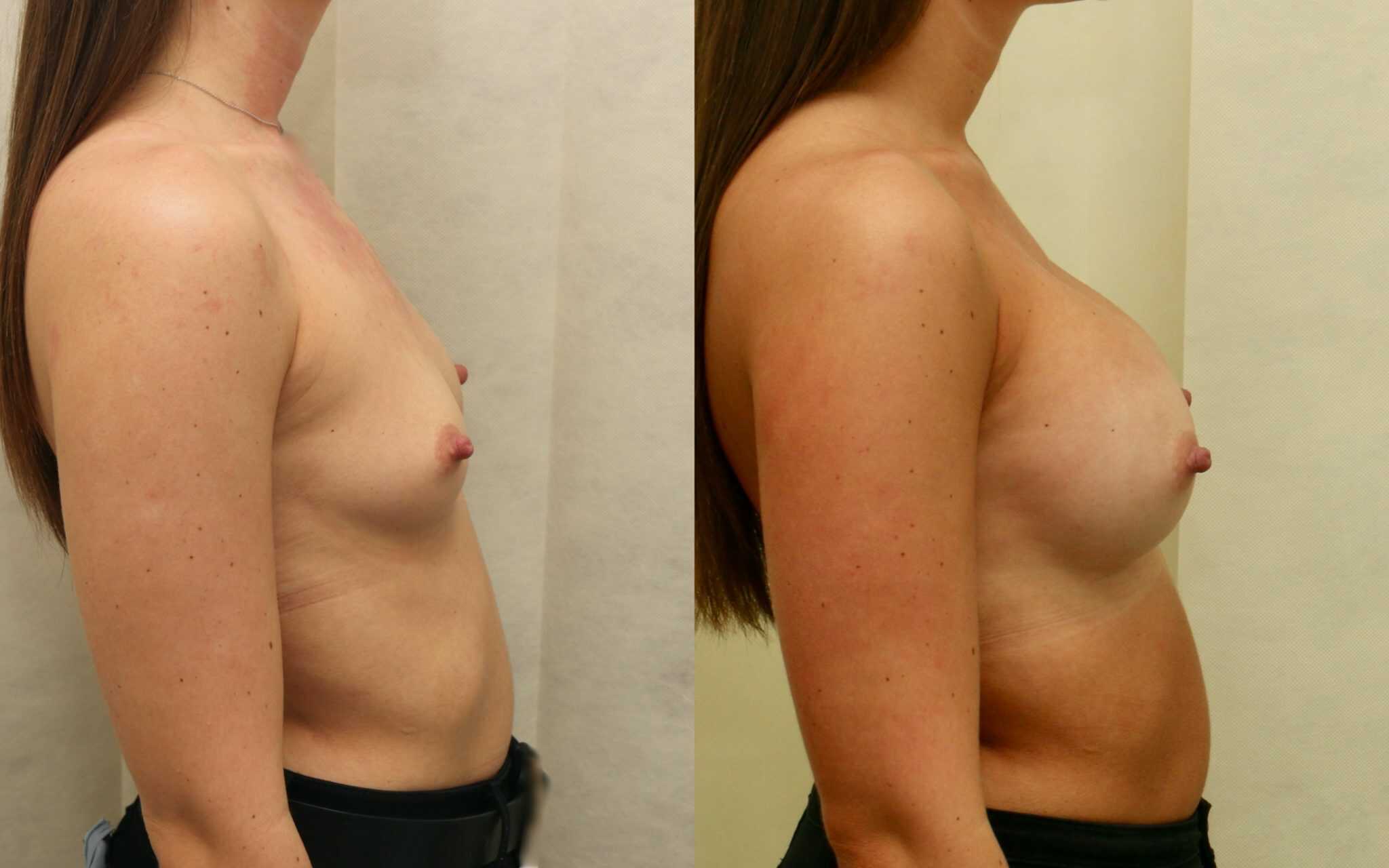 breast implants before and after