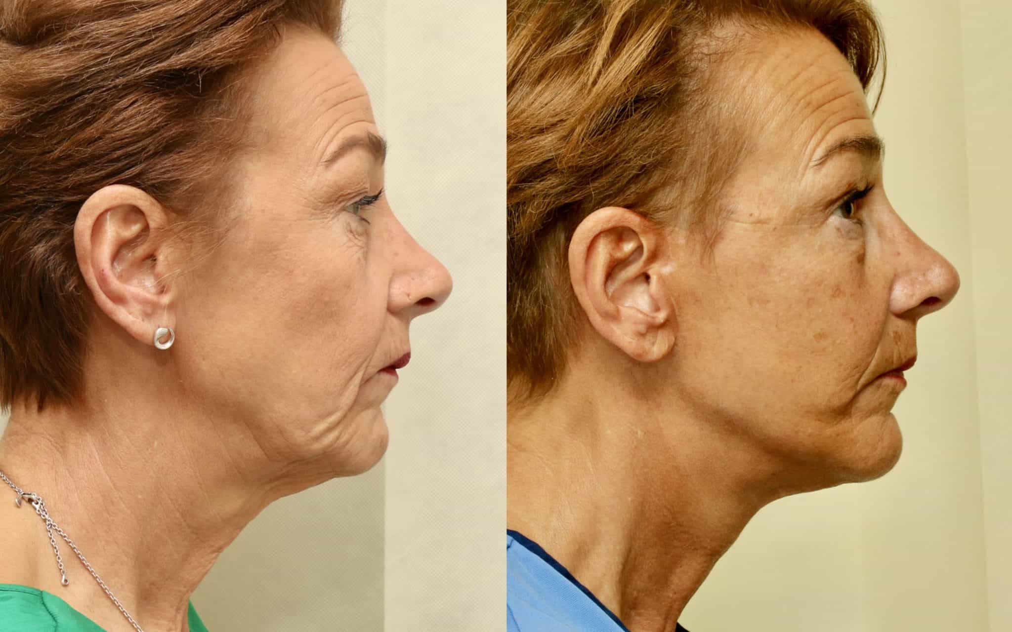 Before and after facelift, 6 days and 6 months post op