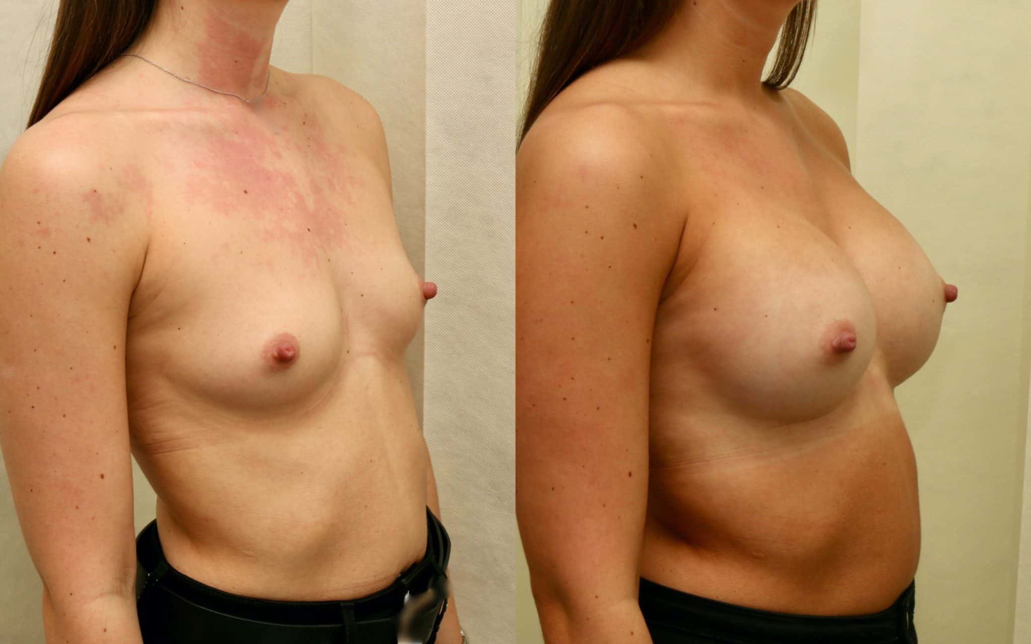 breast implants before and after