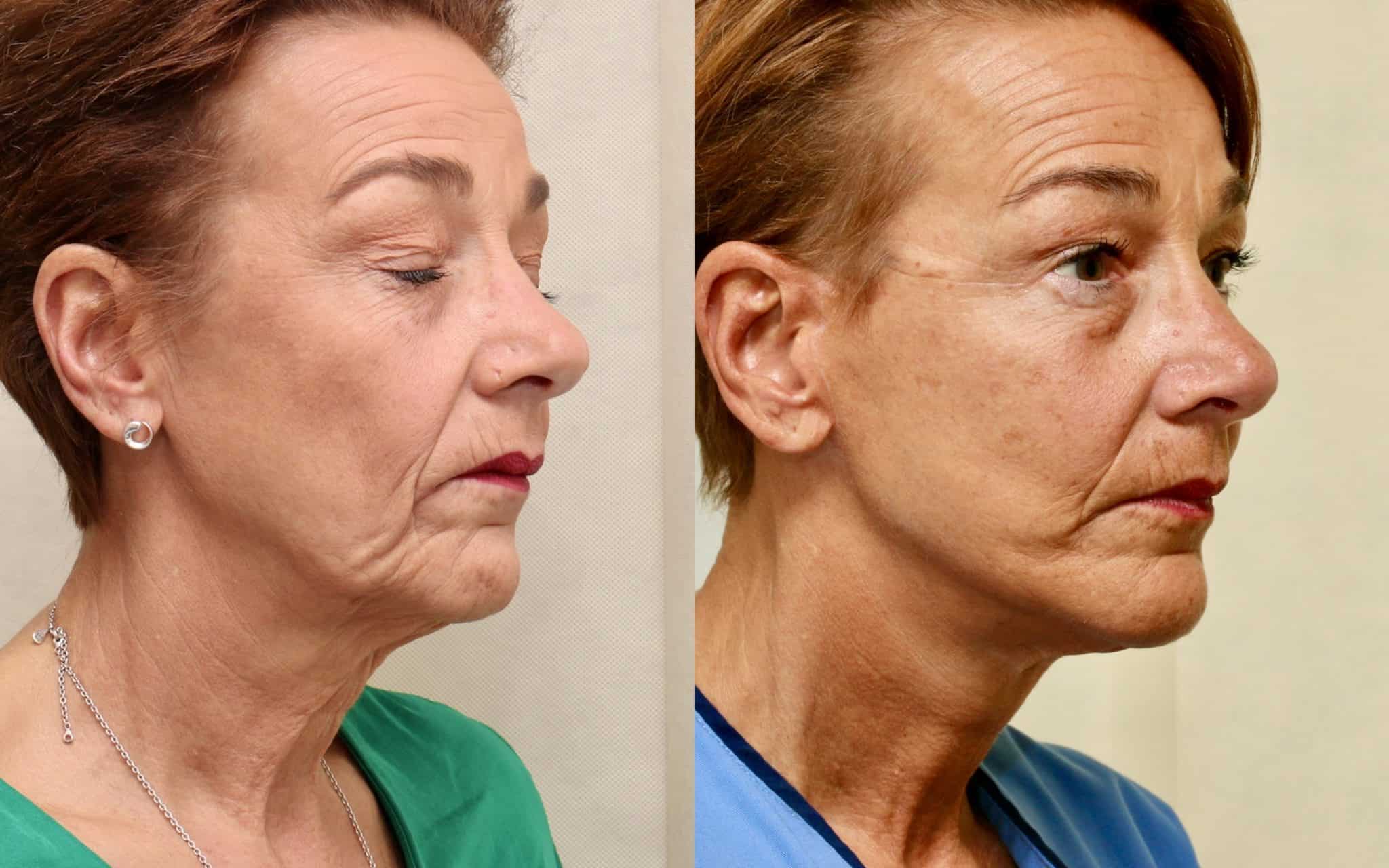 Before and after facelift, 6 days and 6 months post op
